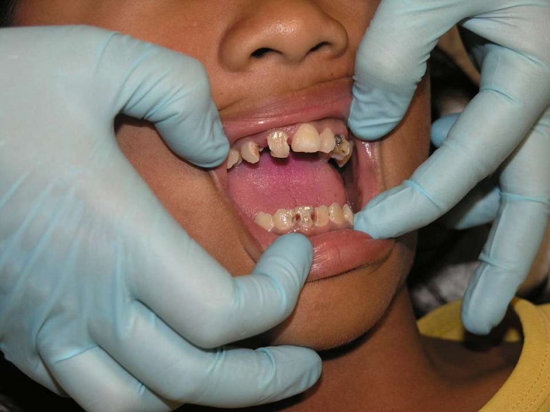 牙齿不好常用这些养生穴位牙痛牙出血和口臭不见了
